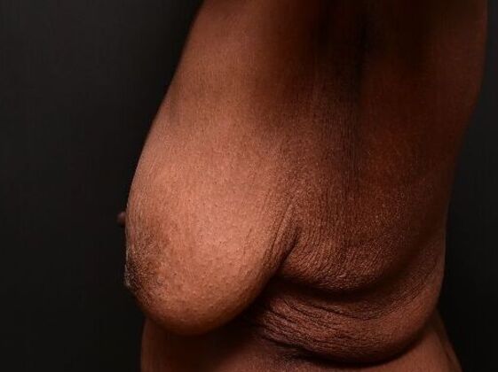 Breast Lift: Case 9 - Before