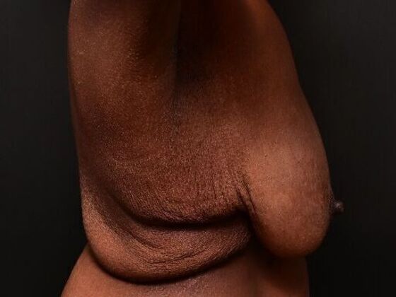 Breast Lift: Case 9 - Before