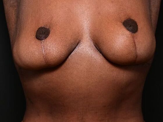 Breast Lift Case 9 - After