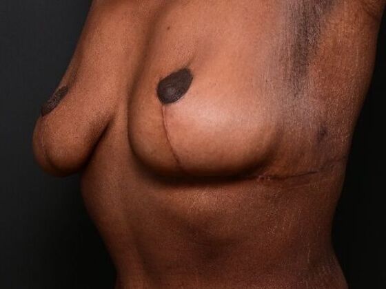 Breast Lift: Case 9 - After