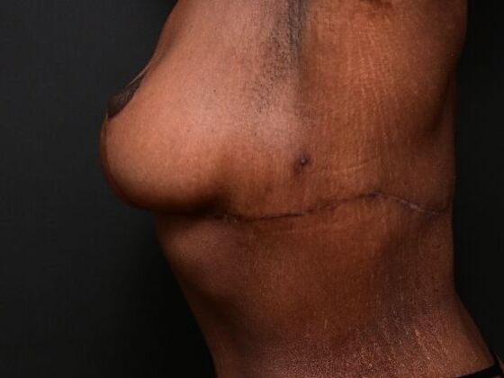 Breast Lift: Case 9 - After