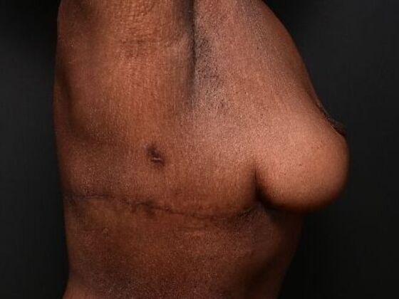 Breast Lift: Case 9 - After