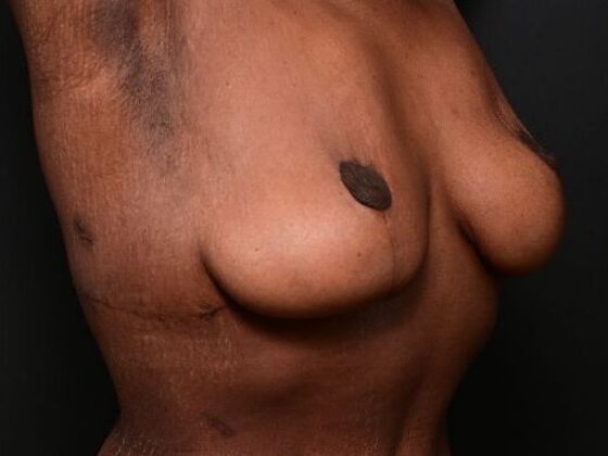 Breast Lift: Case 9 - After