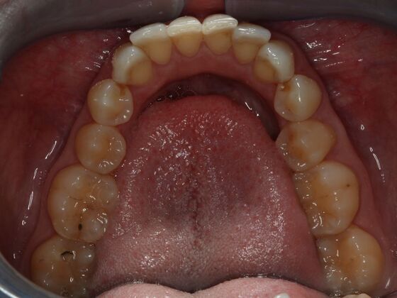 Invisalign Case 3 - Before
