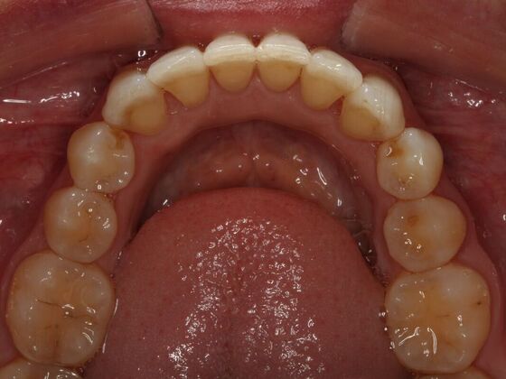 Invisalign Case 3 - After