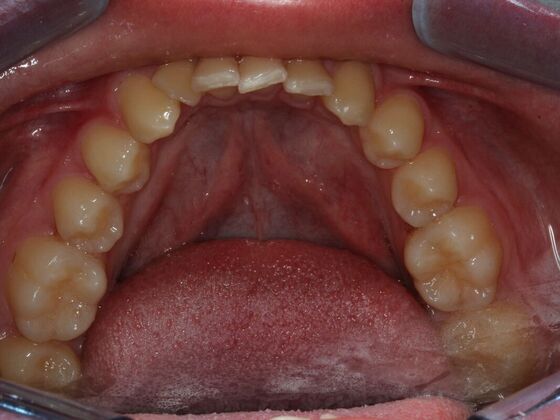 Invisalign Case 4 - Before