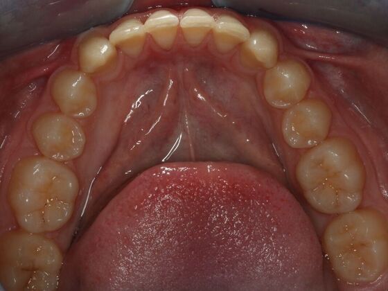 Invisalign Case 4 - After