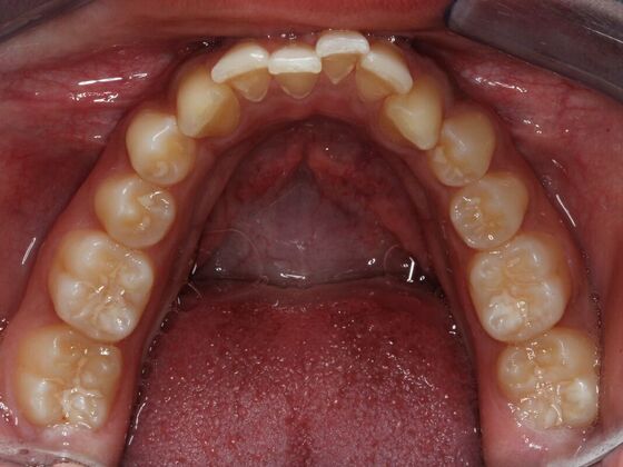 Invisalign Case 5 - Before
