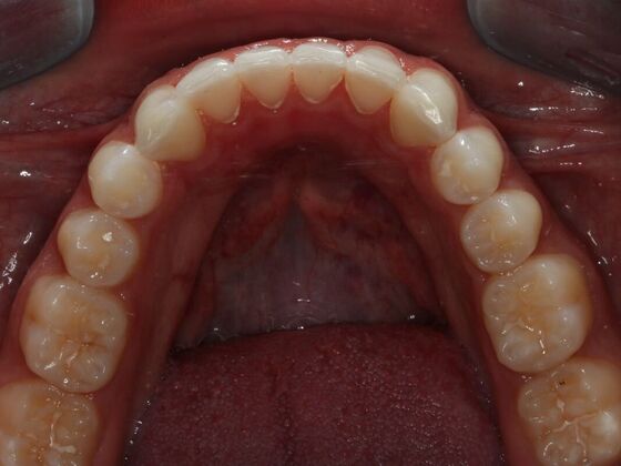 Invisalign Case 5 - After