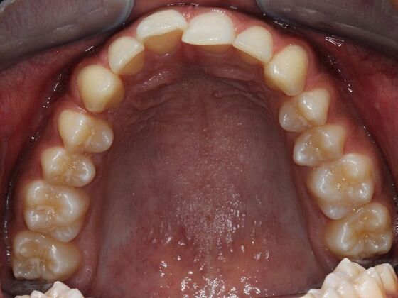 Invisalign Case 6 - Before