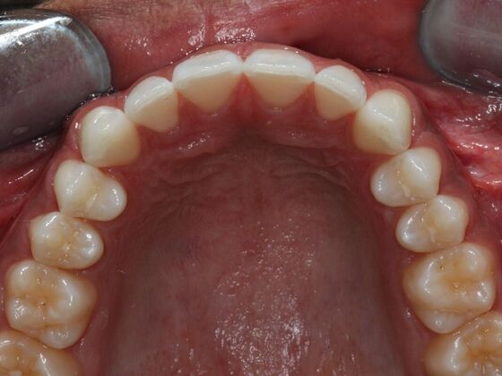Invisalign Case 6 - After