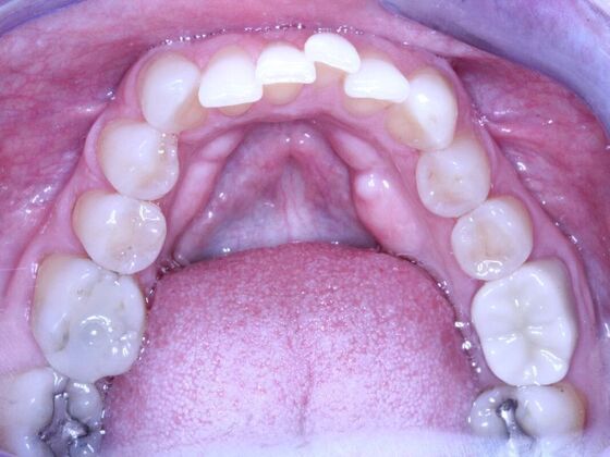 Invisalign Case 7 - Before