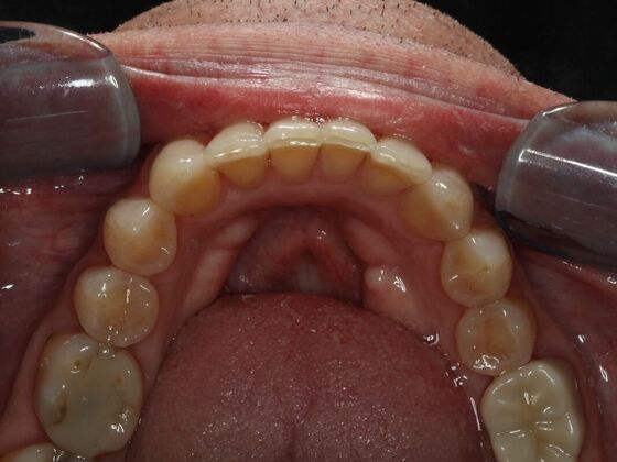Invisalign Case 7 - After