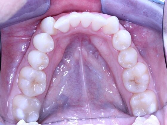 Invisalign Case 8 - Before
