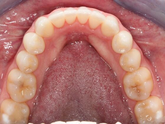 Invisalign Case 8 - After
