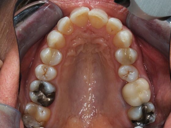 Invisalign Case 9 - Before