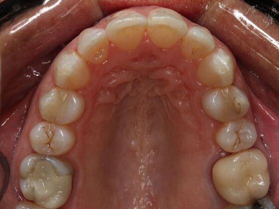 Invisalign Case 9 - After
