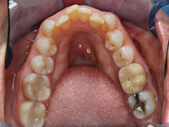 Invisalign Case 10 - Before