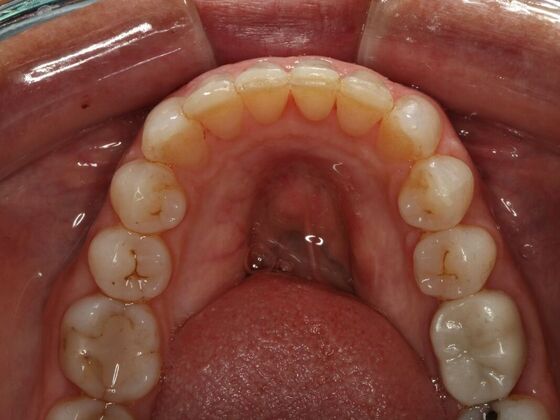 Invisalign Case 10 - After