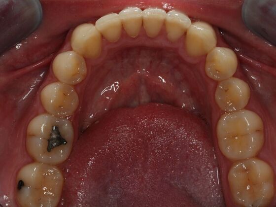 Invisalign Case 11 - After
