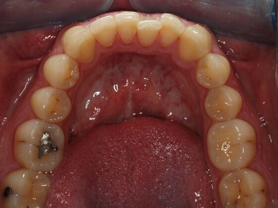 Invisalign Case 11 - Before