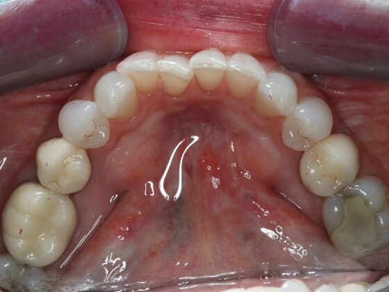 Invisalign Case 12 - Before