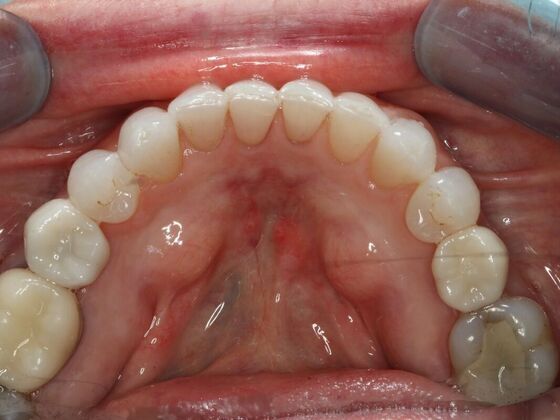Invisalign Case 12 - After