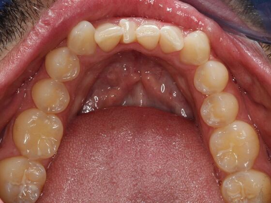 Invisalign Case 13 - Before