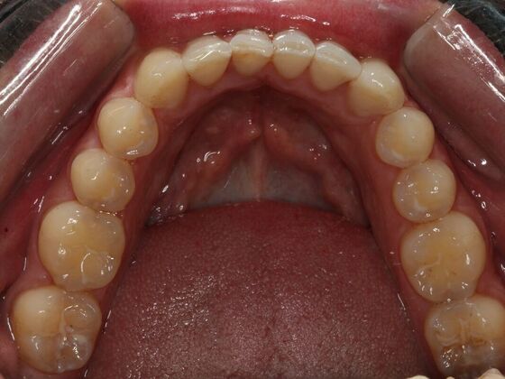 Invisalign Case 13 - After