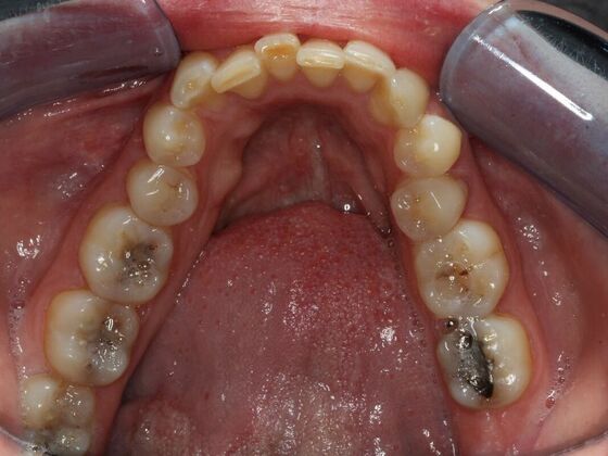 Invisalign Case 14 - Before