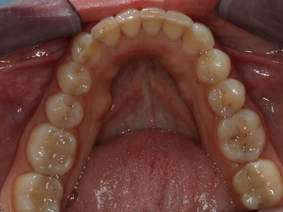 Invisalign Case 14 - After