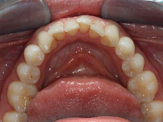 Invisalign Case 15 - Before
