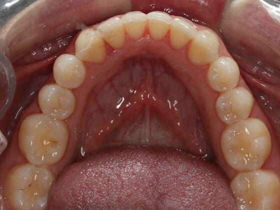 Invisalign Case 15 - After
