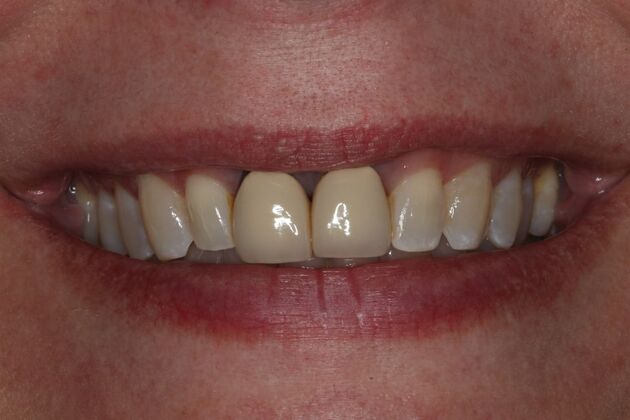 Crowns Case 1 - Before