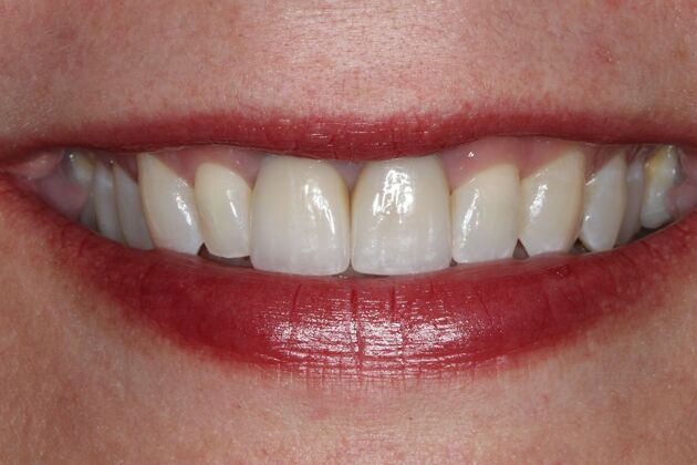 Crowns Case