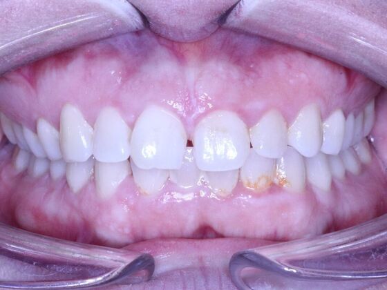 Invisalign Case 16 - Before