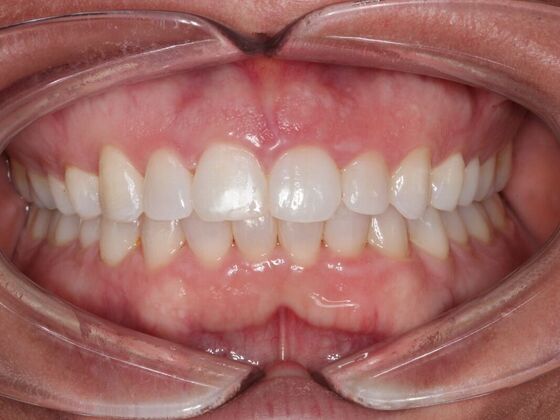 Invisalign Case 16 - After