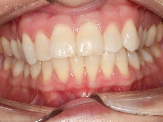 Invisalign Case 17 - Before