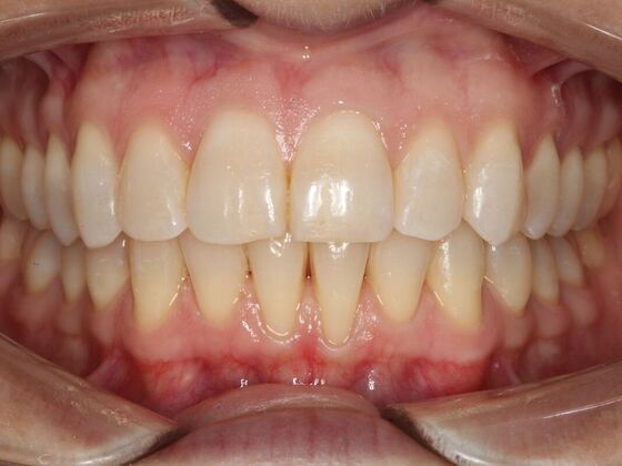 Invisalign Case 17 - After