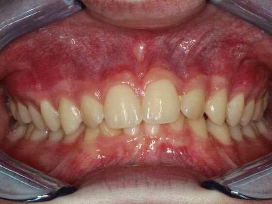 Invisalign Case 18 - Before