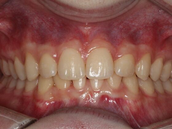 Invisalign Case 18 - After