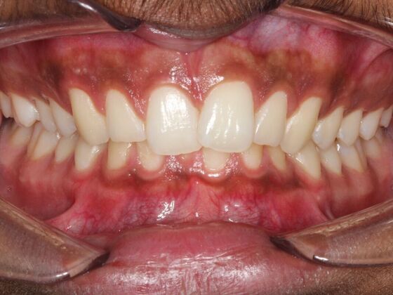 Invisalign Case 19 - Before