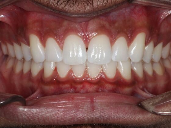Invisalign Case 19 - After