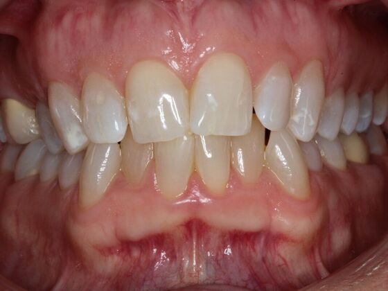 Invisalign Case 20 - Before