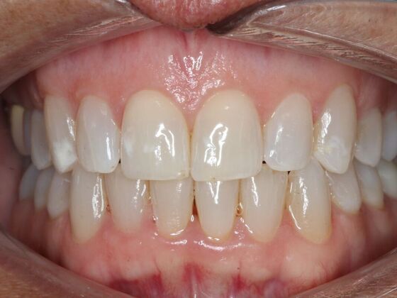 Invisalign Case 20 - After