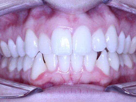 Invisalign Case 21 - Before