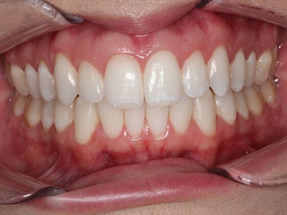 Invisalign Case 21 - After