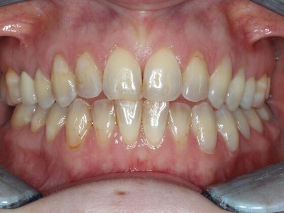 Invisalign Case 22 - Before