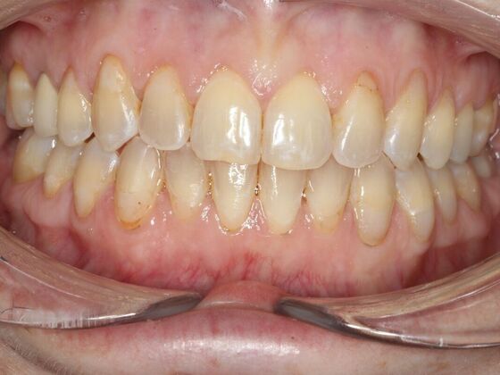Invisalign Case 22 - After
