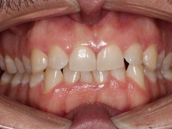 Invisalign Case 23 - Before